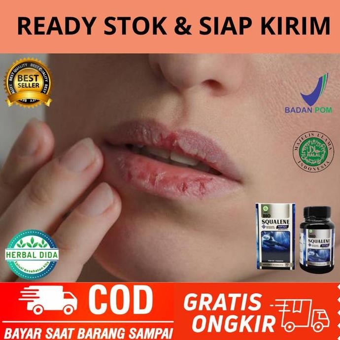 Obat Bibir Pecah Pecah, Obat Bibir Luka, Obat Bibir Pecah Kering