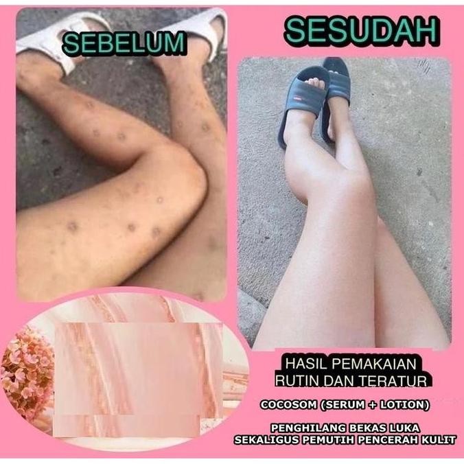PENGHILANG BEKAS LUKA LAMA KULIT GATAL MENGHITAM + PEMUTIH KULIT KORENG BUDUK COCOSOM SERUM LOTION K