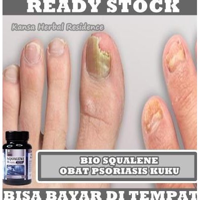 NEW Obat Psoriasis Kuku, Obat Jamur Kuku, Obat Kuku Kuning Rusak Parah