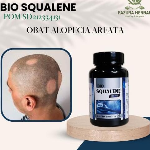 Obat Mengatasi Alopecia Areata, Obat Rambut Pitak Obat Penumbuh Rambut