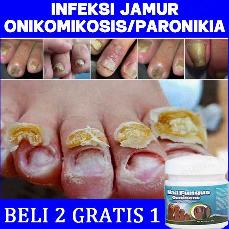 Obat Kuku Jamur Dan Rusak Obat Jamur Kuku Salep Kuku Jamur Dan Rusak Salep Jamur Kuku Obat Cantengan