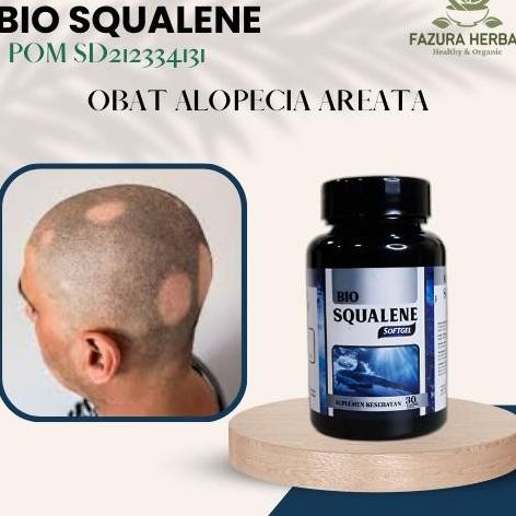 Obat Mengatasi Alopecia Areata, Obat Rambut Pitak Obat Penumbuh Rambut
