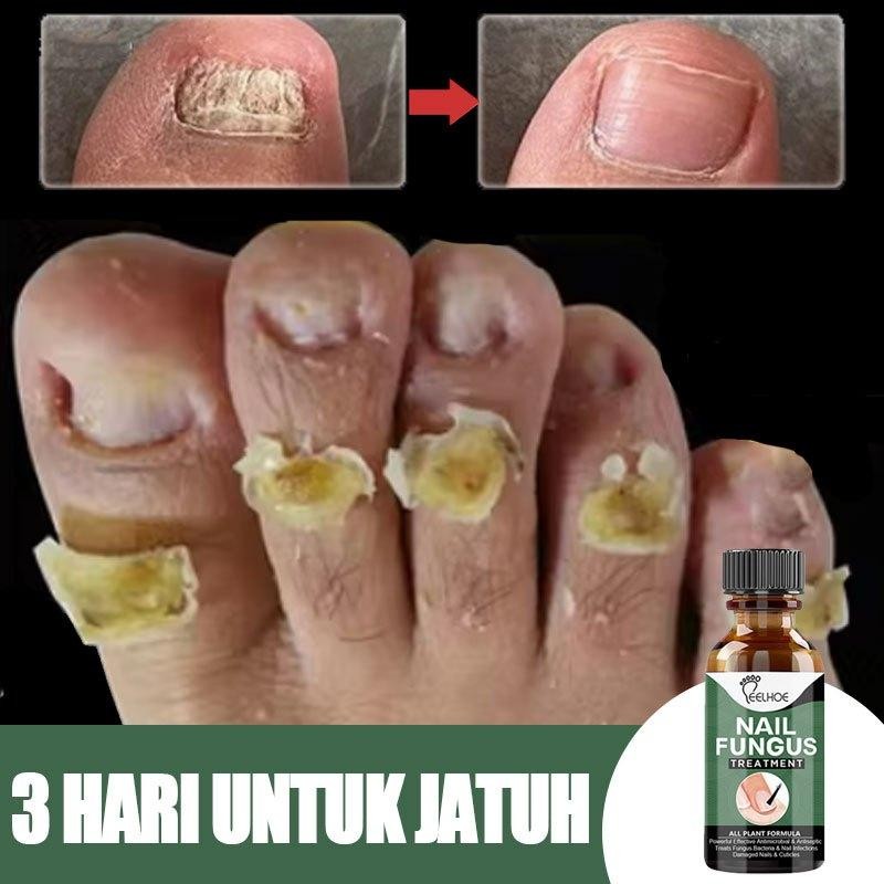 Obat Jamur Kuku Serum Kuku Jamur Dan Rusak Obat Kuku Obat Cantengan Vitamin Kuku Dan Kutikula Lanben