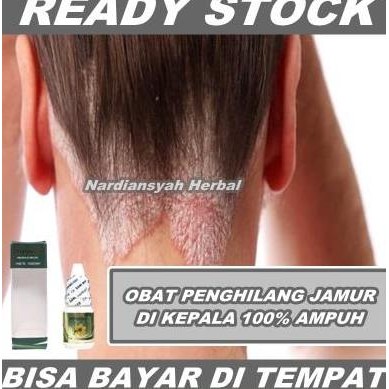 TERMURAH - Obat Ketombe Rambut Untuk Anak & Dewasa - Penghilang Ketombe Alami