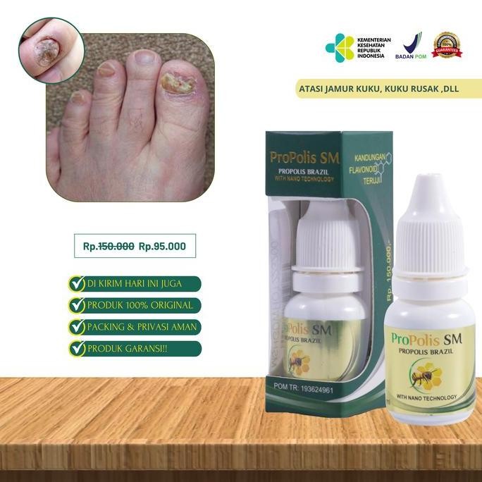 BEBAS ONGKIR - Propolis SM - Obat Kuku Jamur Rusak, Kuku Bau Busuk, Kaki Jamur Rusak Cantengan Jempo