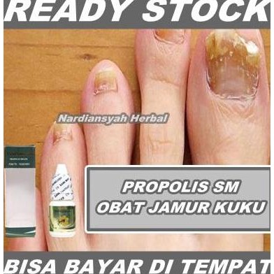 Obat Jamur Kuku, Infeksi Jamur Kuku, Salep Jamur Kuku di Tangan & Kaki