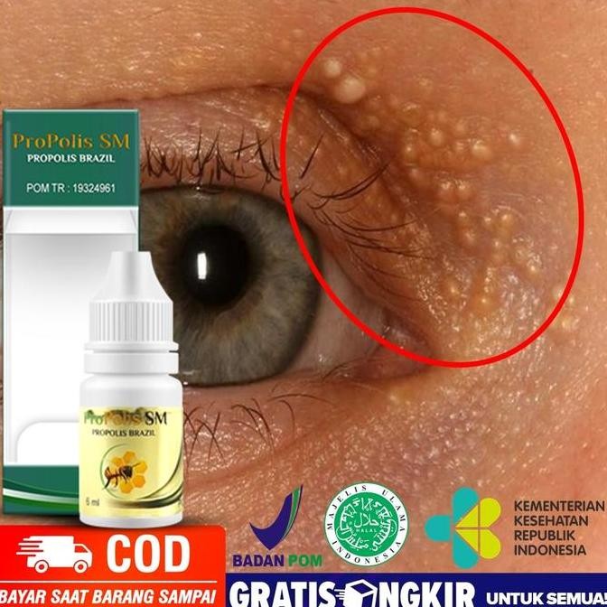 BEBAS ONGKIR - Propolis SM Obat Menghilangkan Milia, Jerawat Milia, Milia di Hidung
