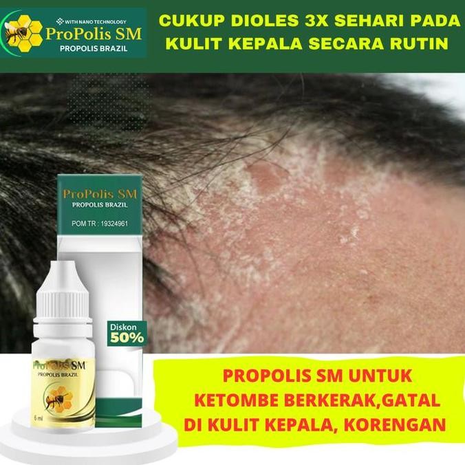 BEBAS ONGKIR - Propolis sm Salep Untuk Ketombe Berkerak, Kulit Kepala Bersisik