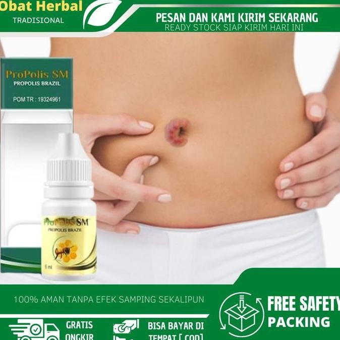 NEW Propolis SM Cairan Tetes Pusar Bernanah Bau Busuk, Gatal Pusar, Pusar Berair, Pusar Bengkak Untu