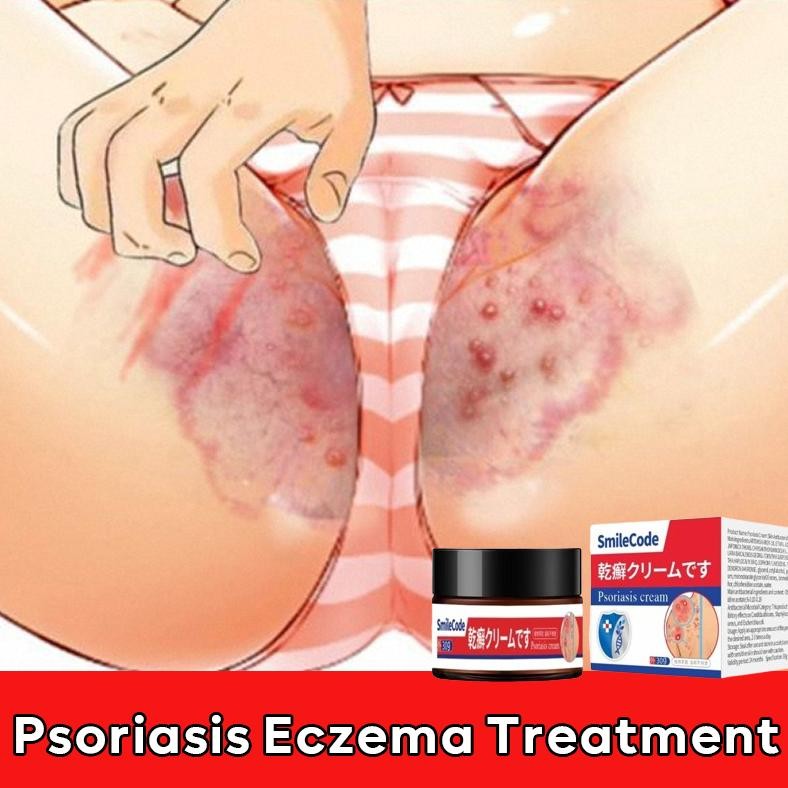 Psoriasis ointment,Salep gatal Salep psoriasis 30g Obat gatal cepat menyembuhkan gatal eksim krim ps