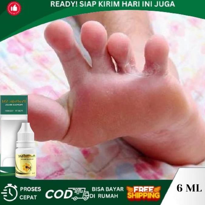 BEBAS ONGKIR - Kutu Air, Kuman Air, Penghilang Kutu Air, infeksi Jamur DiKaki, Penghilang Kuman Air,