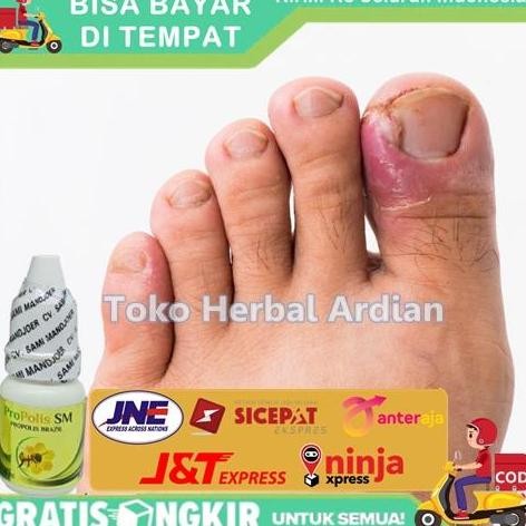 TERBARU - Obat Herbal Cantengan Kuku Jempol Kaki, Tangan Bengkak & Bernanah BPOM
