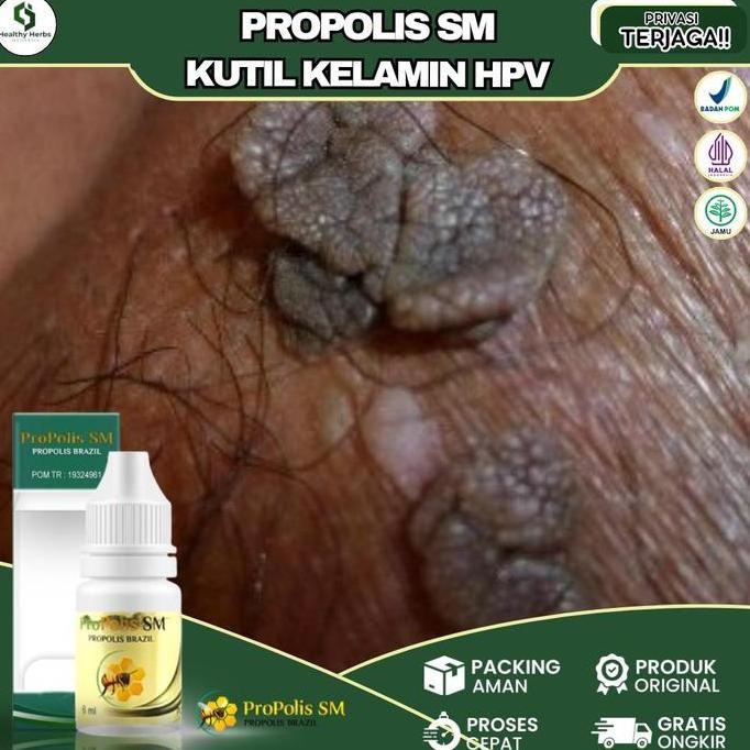 Propolis Sm Perontok Kutil Kelamin Kutil Anus Kutu Jamur Kemaluan Gatal Lecet Virus Hpv Klamidia Sip