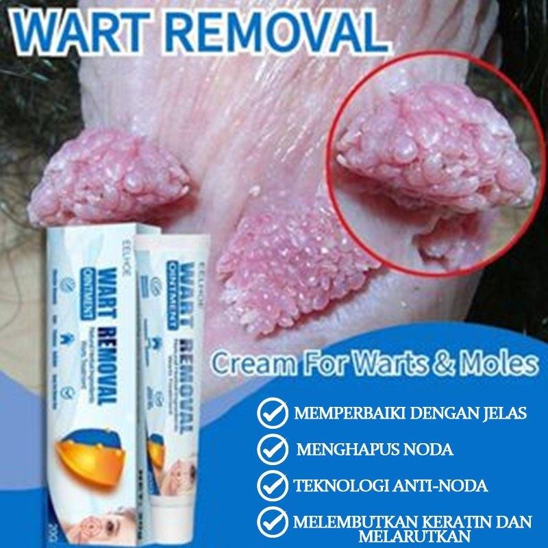 Obat Kutil Penghilang Kutil Dan Tahi Lalat Wart Remover Penghilang Kutil Di Wajah Salep Kutil Ampuh 
