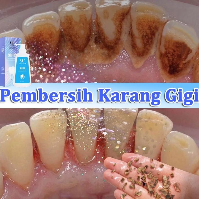 perontok karang gigi odol pemutih gigi odol pemutih gigi dan karang gigi 100ml pembersih karang gigi