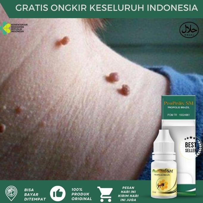 TERLARIS - Kutil Papiloma di Leher, Perontok Kutil Dileher, Penghilang Papiloma, Papiloma di Wajah, 