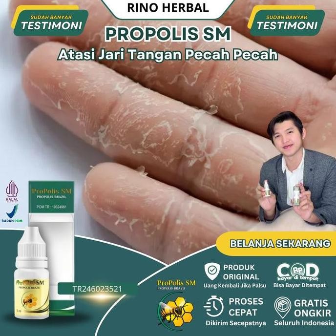 TERLARIS - Salep Jari Tangan Pecah Pecah, Jari Tangan Kering, Jari Tangan Kering dan Pecah, Kulit Ja