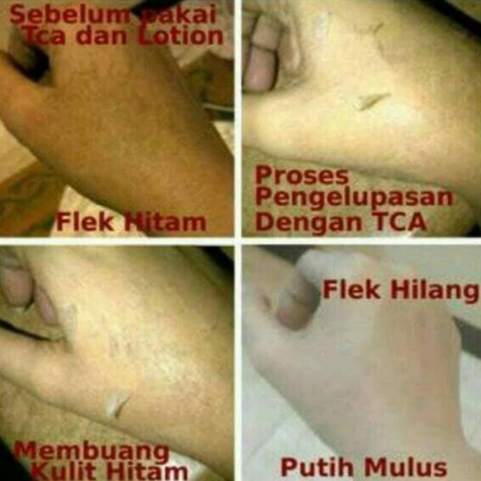 TERBARU TCA Peeling 20% | Peeling Cair 100ml - Bibit Pemutih Kulit Badan Tubuh