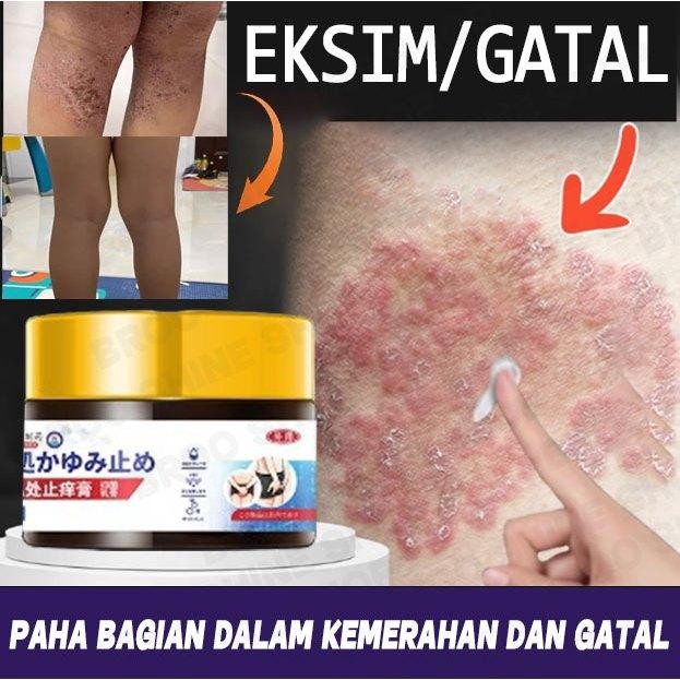 Salap gatal kulit yang ampuh obat gatal selangkangan salep gatal selangkangan obat eksim Anti jamur