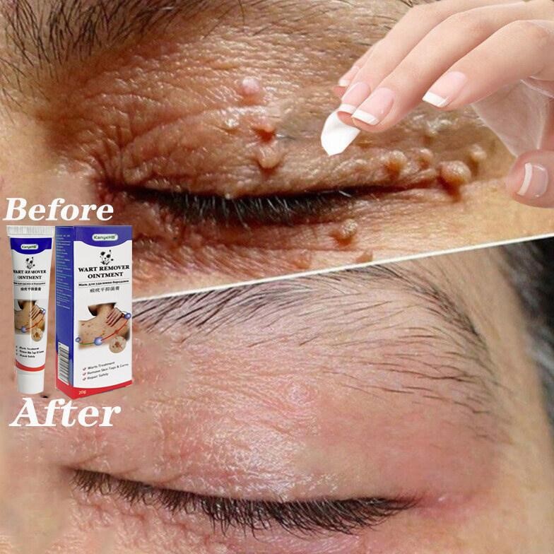 Krim Penghilang Kutil, Obat Penghilang Kutil Wajah, Obat Penghilang Kutil Leher MURAH