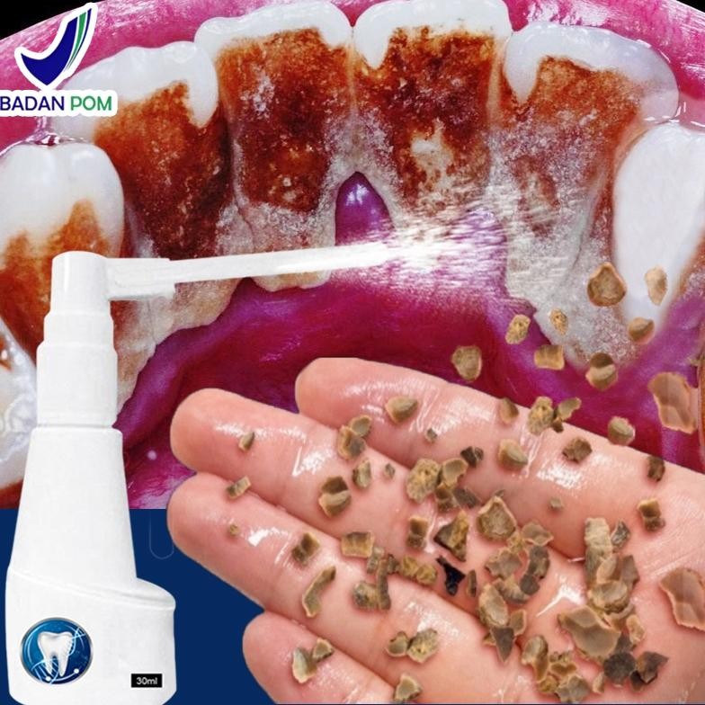 Perontok karang gigi paling ampuh Penghilang karang gigi Pembersih karang gigi berkerak 30ml alat pe
