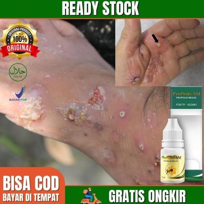 TERLARIS - Obat Salep Kulit Cenang Borok Budukan Bernanah Cacar Air Dermatitis