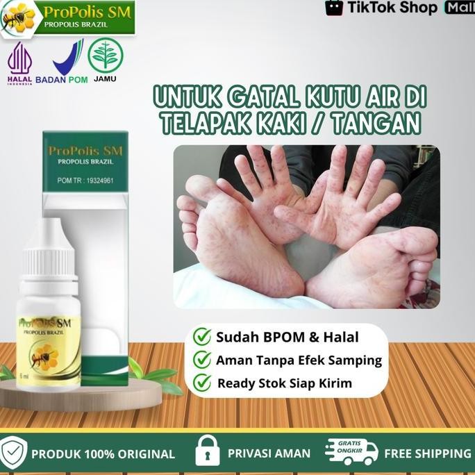 Propolis SM - Untuk Gatal Kutu Air Di Sela Jari Kaki Dan Telapak Kaki, Gatal Ruam Berisi Cairan