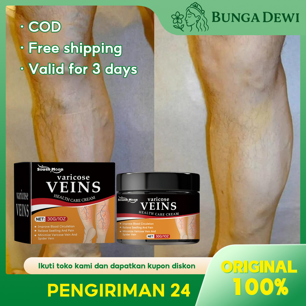 South Moon Varicose Veins Cream 30g Krim Varises Meredakan Nyeri Dan Bengkak, Memperbaiki Varises Da