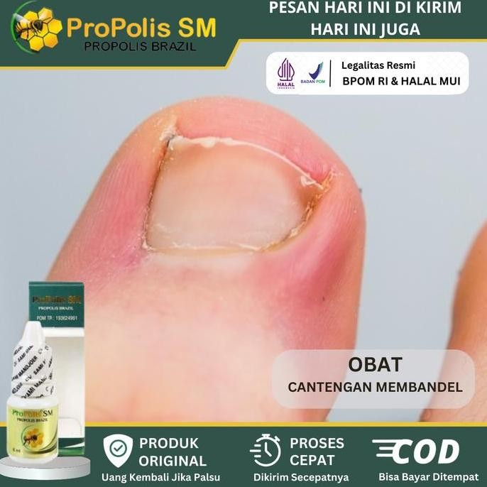 Propolis SM Perawatan Untuk Cantengan Jempol Kaki Tangan, Bengkak, Bernanah Berdarah, Kuku Rusak, Ku