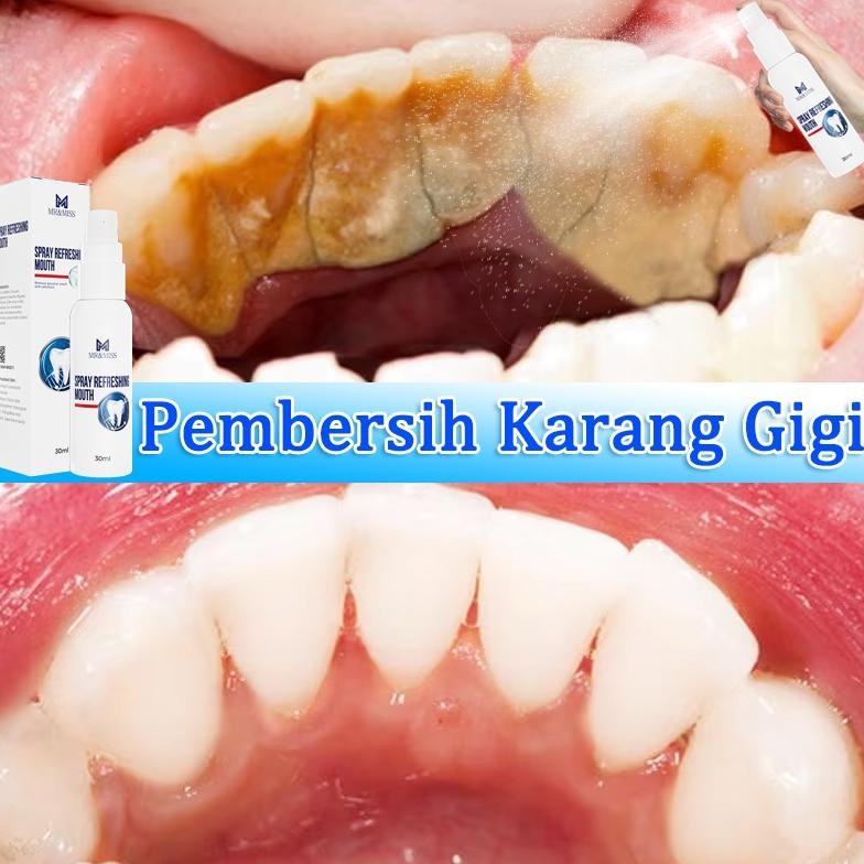 Penghilang karang gigi perontok karang gigi paling ampuh pembersih karang gigi 30ml penghilang karan