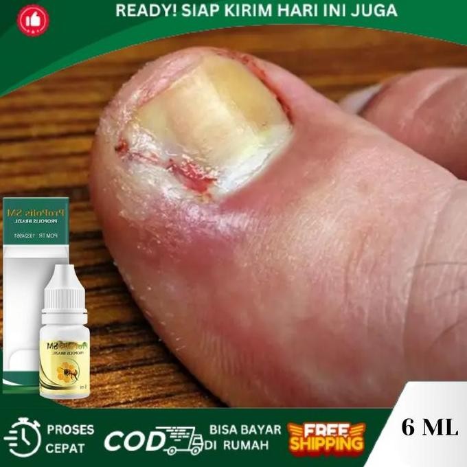 NEW Tetes Cantengan Jempol Kaki, Kuku Jempol Nyeri Bau Busuk, Jempol Kaki Bengkak Bernanah, Kuku Jam