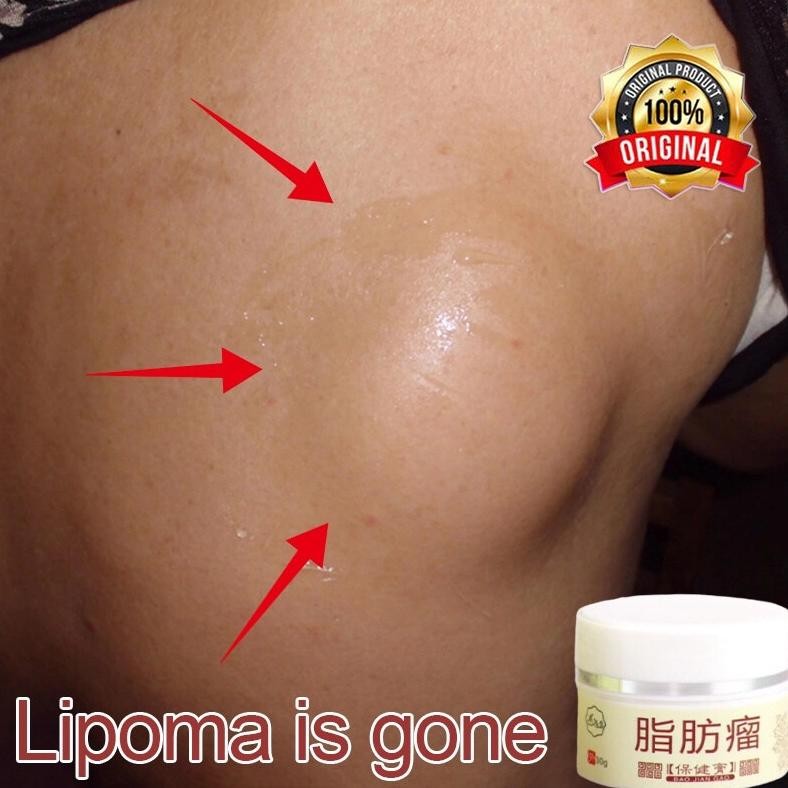 Obat Benjolan Lipoma Krim lipoma Obat oles penghilang  Benjolan  lipoma 30g Obat Kista Ganglion/Obat