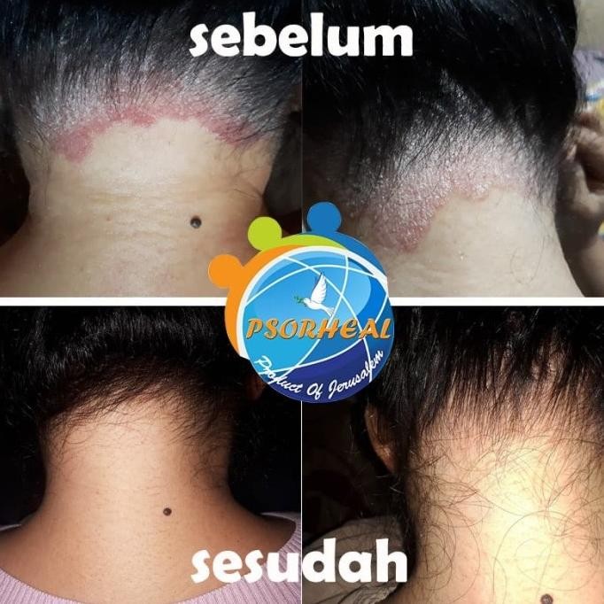 Diskon Paket Cream TANPA SHAMPO Ketombe Parah Psoriasis SCALP PSORHEAL ISRAEL