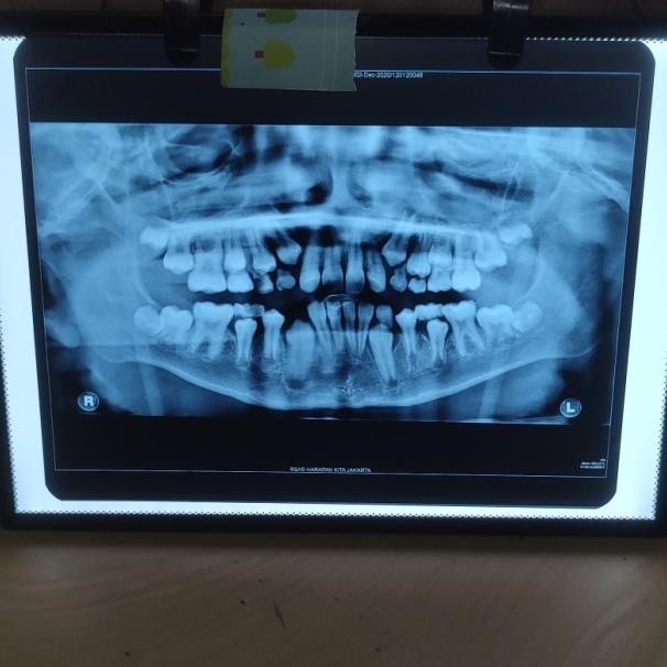 Dental Viewer X Ray Led Rontgen A4 Slim / Lampu Baca Rontgen