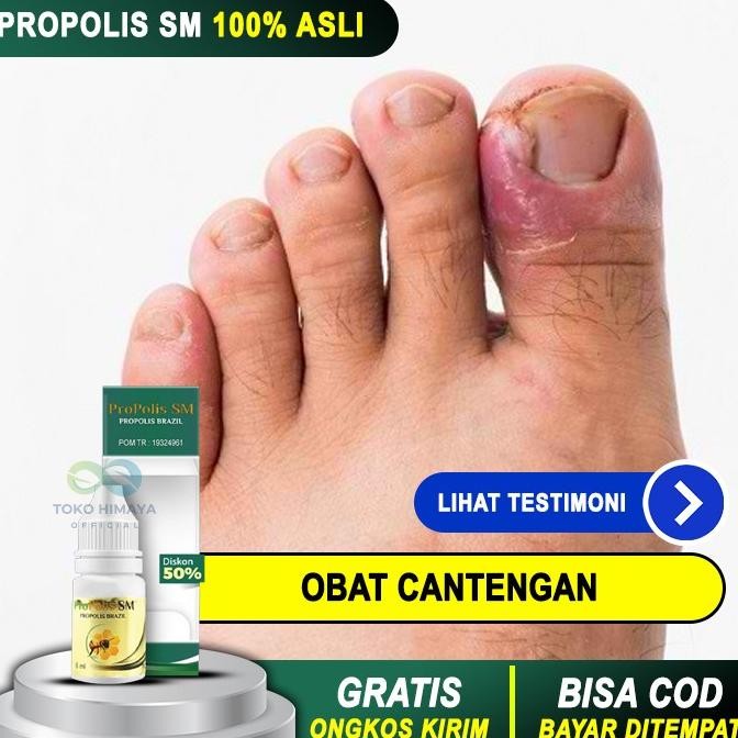 BEBAS ONGKIR - OBAT CANTENGAN JEMPOL KAKI - Kuku Tangan Bengkak dan Bernanah - BPOM