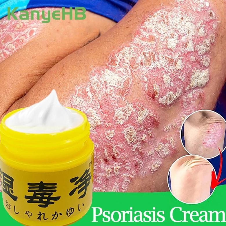 1/3/5pcs against psoriasis treatment cream inhibit fungi dermatitis eczema skin rash urticaria desqu