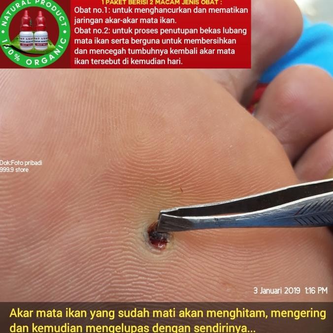 Obat penyakit mata ikan atau clavus bukan plester salep callusol