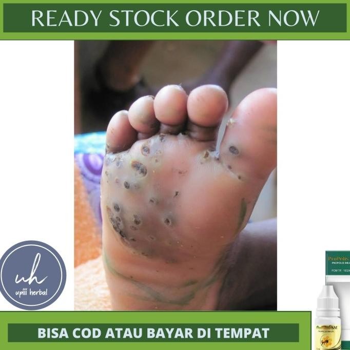 NEW OBAT UNTUK KAKI KAPALAN,PENGHILANG KAPALAN,MATA IKAN DIKAKI,TANGAN,DLL