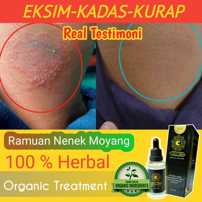 Obat Kadas Kurap Eksim Kudis Paling Ampuh Obat Gatal Selangkangan