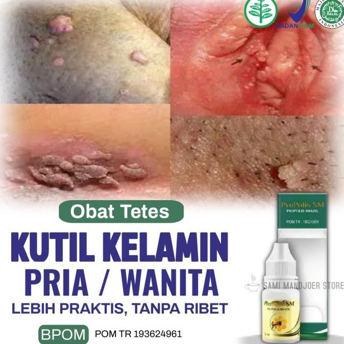 Propolis Sm - Salep Kutil Kelamin, Obat Kutil Di Kelamin Kutil Di Anus