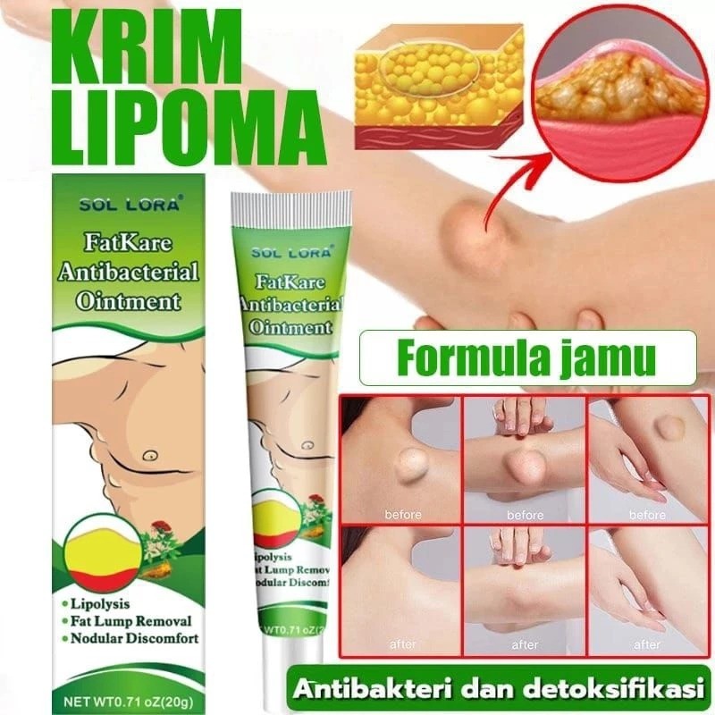 lipoma cream salep benjolan 100% Original Herbal Ampuh lipoma cream salep benjolan 7 days lipoma rem