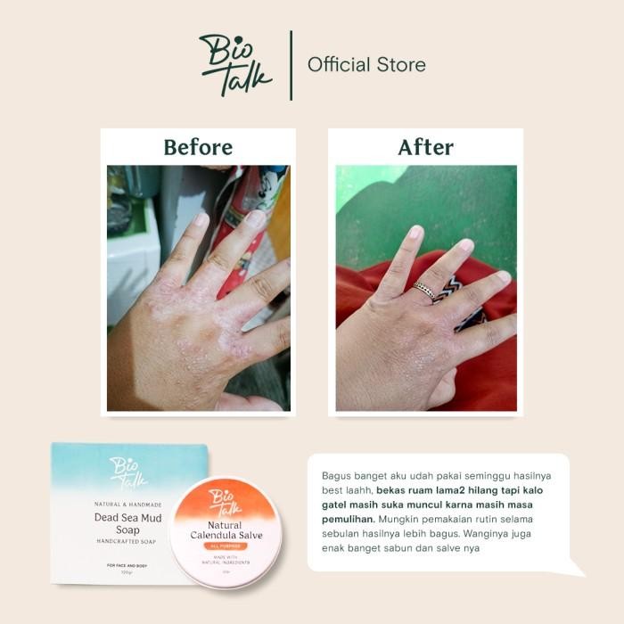 Biotalk Bundle Gatal Dan Ruam | Salep Sabun Melembapkan Bagus Untuk Kulit Gatal Alergi Iritasi Ruam