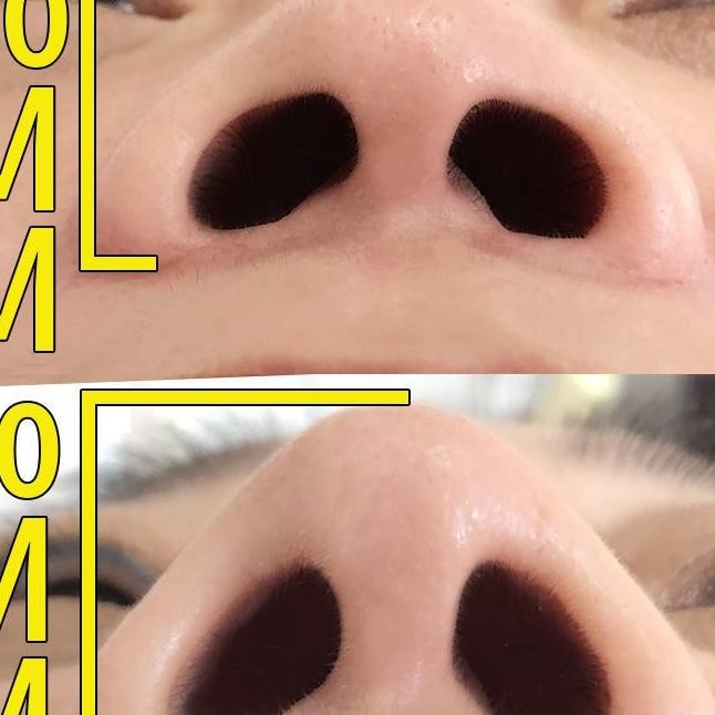 Cairan Pemancung Hidung, Hidung Menjadi Kecil, Hidung Menjadi Mancung, Mengobati Pangkal Hidung Runt