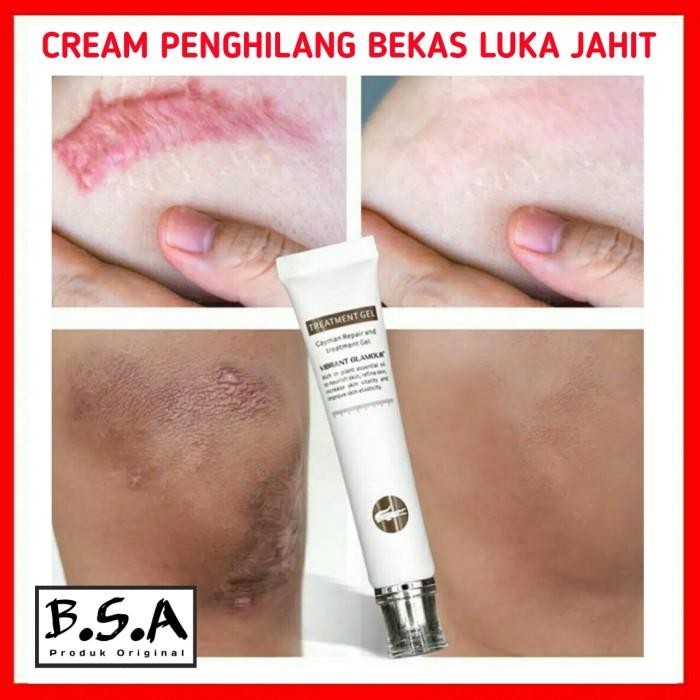Cream Penghilang Bekas Luka Jahit