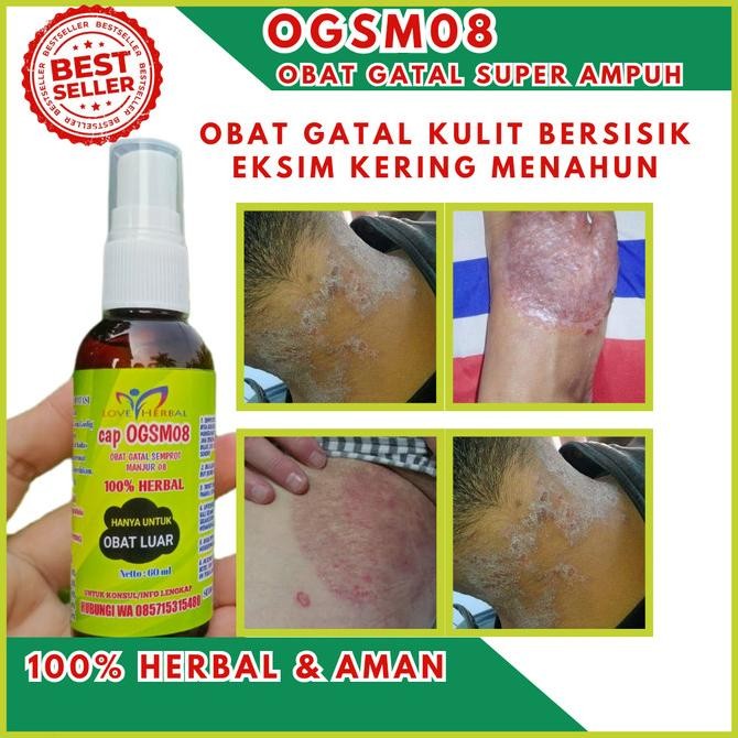 TERJAMIN Obat Gatal Kulit Bersisik Eksim Kering Menahun OGSM08