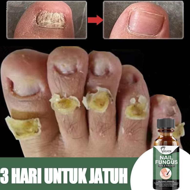 Obat Jamur Kuku Serum Kuku Jamur Dan Rusak Obat Kuku Obat Cantengan Vitamin Kuku Dan Kutikula Lanben