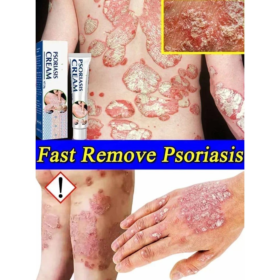 herbal antibacterial cream psoriasis fast treatment ointment relieve itching cure eczema rash urtica