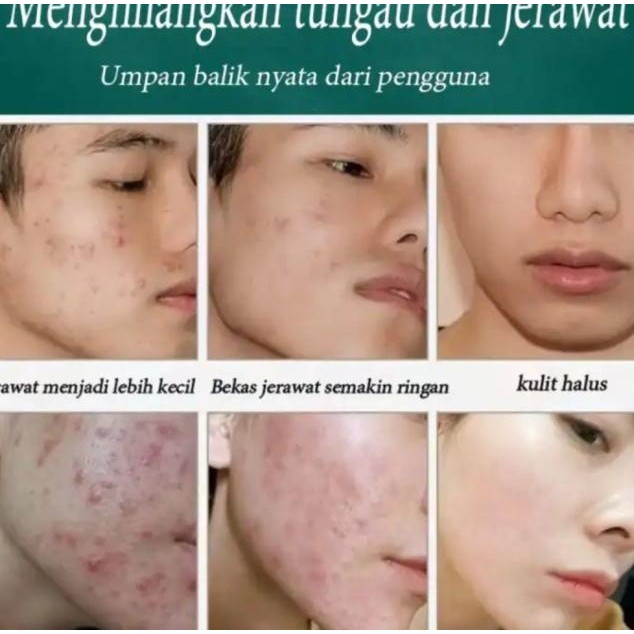 Nicor Pembersih Wajah Pria Sabun Cuci Muka Ghilang Jerawat