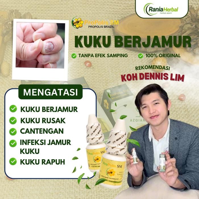 Propolis Sm - Atasi Kuku Berjamur, Kuku Rusak Bau, Kuku Jamuran Rusak, Cantengan Jempol kaki