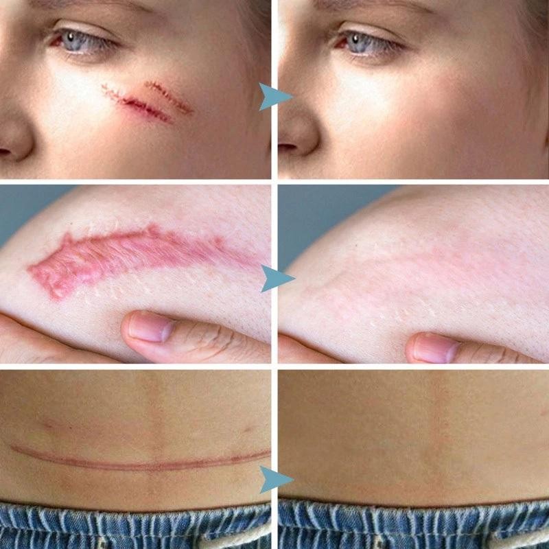 Penghilang Bekas Luka Hitam Koreng Penghilang Bekas Jerawat Penghilang Bekas Cacar Penghilang Koreng